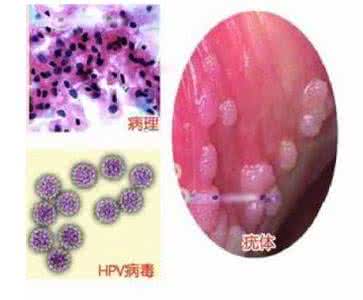子宫癌治疗费用 治疗喉癌.子宫癌