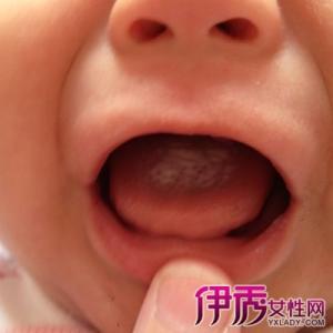婴儿鹅口疮 【健康注意】婴儿鹅口疮？