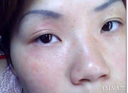 脸部皮肤过敏怎么办 脸部皮肤过敏怎么办 3大技巧有效治疗脸部过敏