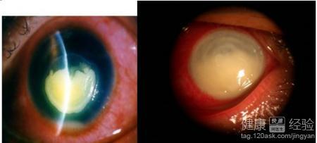 角膜炎用药 用药角膜炎的治疗方法，角膜炎吃什么药角膜炎怎样治疗？
