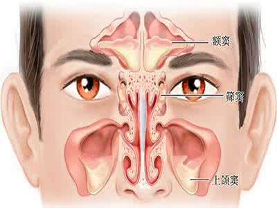 怎么区分鼻炎和鼻窦炎 荐读：“鼻炎”和“鼻窦炎”，如何区分？