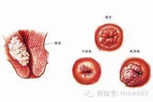 子宫颈癌会死吗 子宫颈癌 为什么会得子宫颈癌