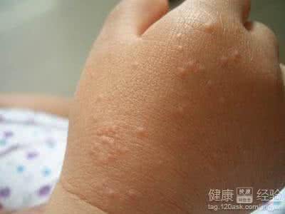 过敏性皮炎多久能痊愈 景颇族秘方：风疹（过敏性皮炎）三天痊愈