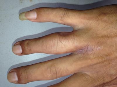 神经性水肿的症状 水肿的症状 如何消除水肿