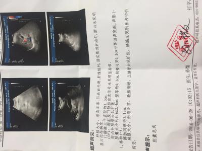胆囊息肉图片 图荐：胆囊息肉的绝密方 1--3疗程内100%痊愈，多年来无一例外  ！