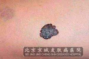 恶性黑色素瘤早期症状 恶性黑色素瘤 恶性黑色素瘤的症状
