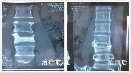 治疗腰椎结核 腰椎结核 怎么样治疗腰椎结核好