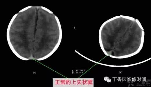 缺氧缺血性脑病恢复期 缺氧缺血性脑病 缺氧缺血性脑病怎么回事