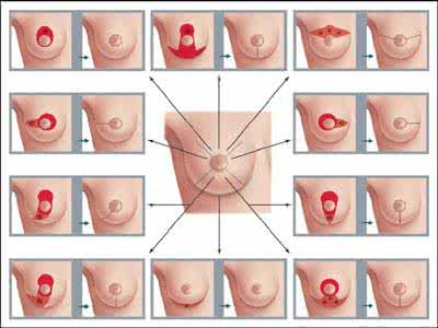 乳腺癌早期治愈率 乳腺癌早期发现5年治愈率达95%