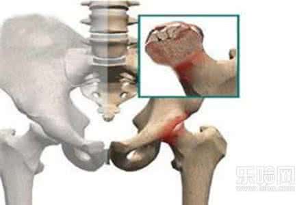 股骨头坏死早期症状 股骨头坏死早期治疗 它的早期症状有哪些