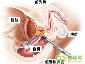 前列腺癌晚期能活几年 备孕 前列腺癌晚期_备孕