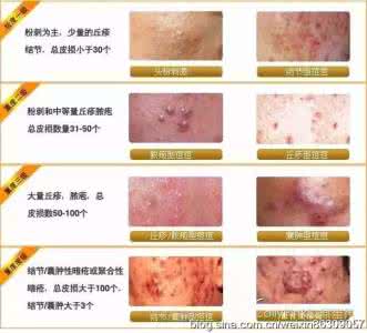 结节性痤疮治疗方法 结节性痤疮是什么 患者治疗痤疮有哪些方法