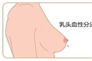 乳头溢液是怎么回事 乳头溢液是怎么回事呢