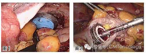 （转载）肠癌特特效方--数例肠癌患者使用过 效果奇特