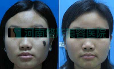 激光去痣需要多少钱 激光去痣要多少钱 激光去痣需要多少钱