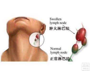 什么是淋巴结节 淋巴结节 什么是淋巴结节