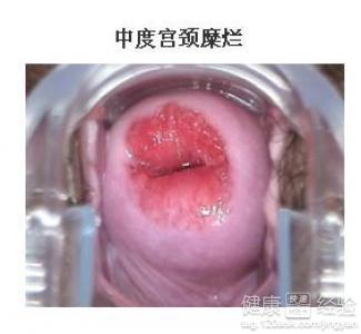 中度宫颈糜烂的症状 宫颈糜烂 中度宫颈糜烂的症状