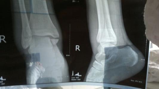 骨裂的症状 骨裂怎么办 它的症状都有哪些