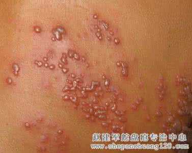 蛇盘疮的症状 蛇盘疮的病因 蛇盘疮的症状与治疗