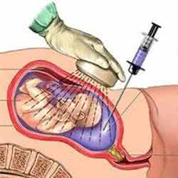 绒毛穿刺检查 绒毛穿刺检查目的是什么