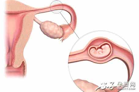 如何防止宫外孕 防止宫外孕 洁净的性生活有助于防止宫外孕
