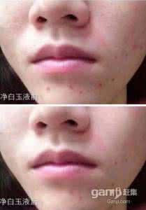 鼻子毛孔粗大怎么办 鼻子毛孔粗大 鼻子毛孔粗大怎么办