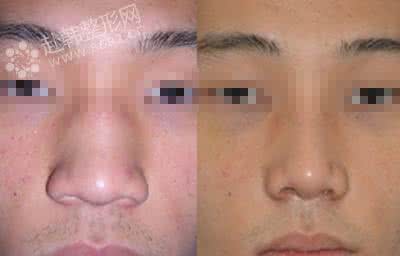 自体软骨隆鼻有后遗症 自体软骨隆鼻有后遗症 隆鼻有后遗症