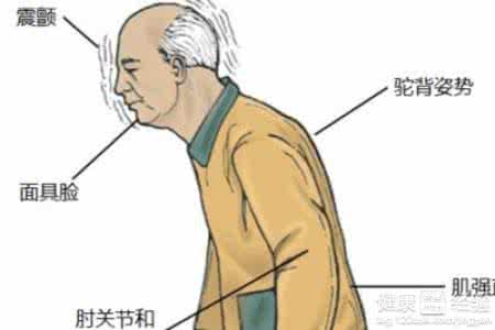 帕金森病人晚期症状 帕金森病人能活多久 帕金森病症状