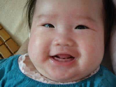 出麻子的症状 小孩出麻子的症状 小孩麻子是什么症状?