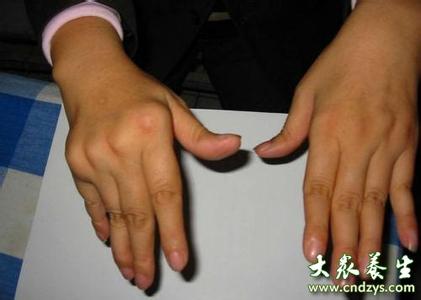 内风湿关节炎的症状 内风湿关节炎的症状 介绍牛皮癣关节炎的症状