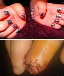 劣质指甲油致截肢 劣质指甲油 劣质指甲油致截肢 长期用指甲油有危害吗