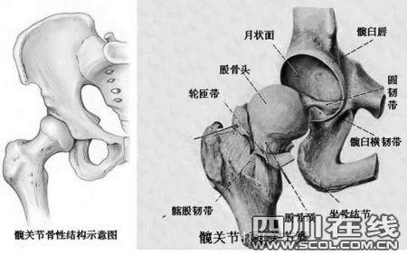 中医对股骨头坏死分型 中医对股骨头坏死分型 中日友好医院分型的L型股骨头坏死仿真三维模型建立_图文