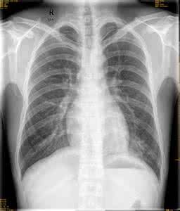 肺炎会传染吗 肺炎