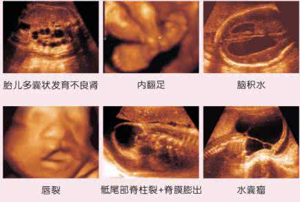 三维彩超主要检查什么 三维彩超什么时候做