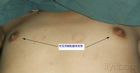 两性畸形 百度百科 两性畸形 百度百科 关于两性畸形与不孕