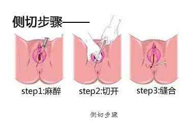 顺产什么情况下侧切 什么情况下需要顺产侧切