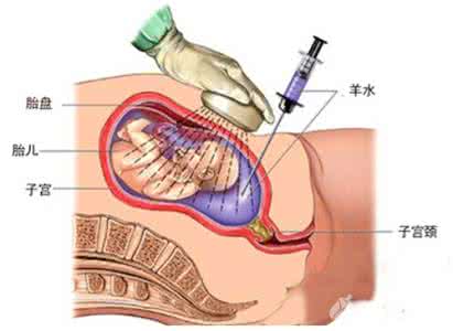 羊水穿刺疼吗 【穿刺疼吗】羊水穿刺疼吗_穿刺疼吗