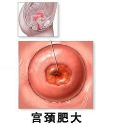 宫颈增生 宫颈增生 宫颈增生是什么原因导致的