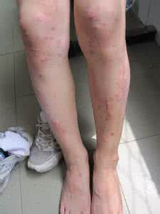 治疗复发性疱疹的方法 治疗复发性疱疹的方法 锻炼能让疱疹不复发吗