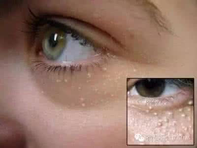 脂肪粒是怎么形成的 【脂肪粒是怎么形成的】脂肪粒是怎么形成的?4招扫除顽固脂肪粒_脂肪粒是怎么形成的