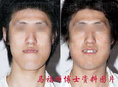兜兜齿自己矫正小妙招 兜兜齿自己能板过来么?