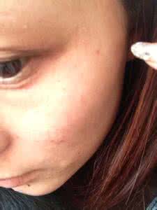 脸部过敏发红发痒 脸过敏发红痒怎么办 脸上过敏发红发痒怎么办