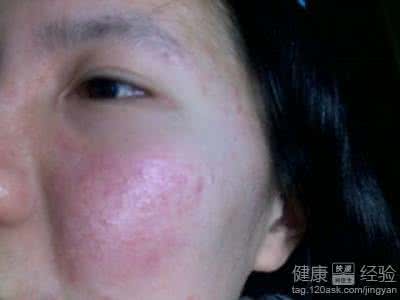 皮肤过敏症状图片 皮肤过敏症状图片 皮肤过敏症状及其护理大搜罗