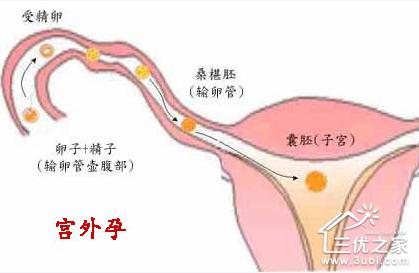 如何预防宫外孕 预防宫外孕 宫外孕有什么表现 如何预防宫外孕的发生