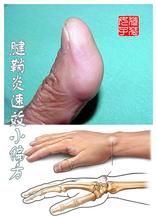 腱鞘炎最佳治疗偏方 腱鞘炎速效小偏方