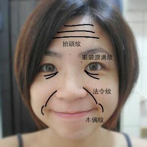 木偶纹 木偶纹 眼袋纹