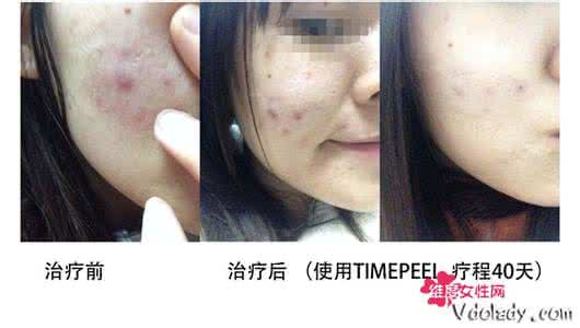 红蓝光治疗痤疮效果 红蓝光治疗痤疮有效吗