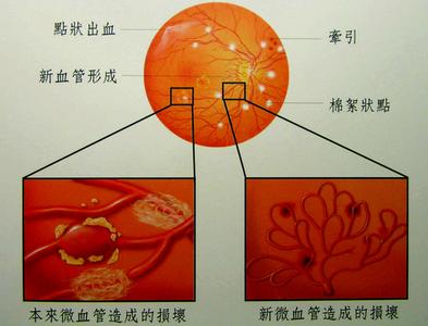 糖尿病性视网膜病变 糖尿病视网膜病变 糖尿病视网膜病变自己有什么感觉？