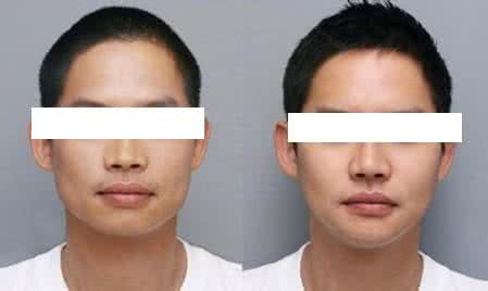 哪些人适合做媚态手术 哪些人适合做瘦脸手术
