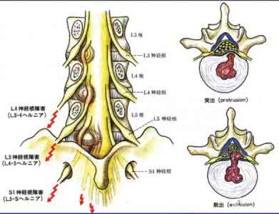 腰椎间盘突出症的锻炼 腰椎间盘突出症的拔罐疗法